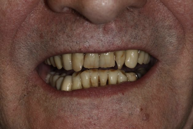 before full mouth reconstruction