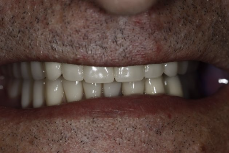after full mouth reconstruction