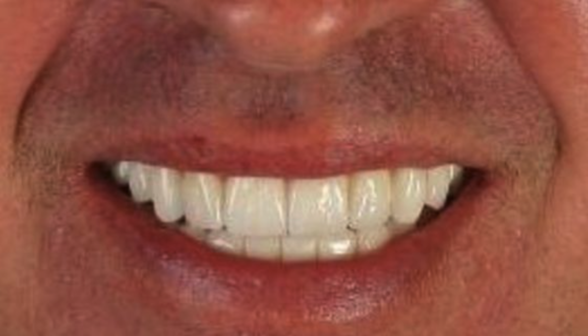 after dental implants