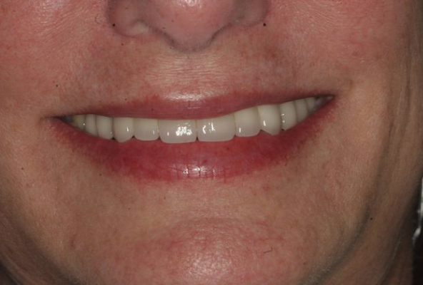 Ridgewood Dental Associates' patient after restorative dentistry