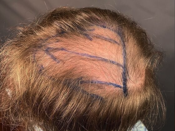 Dr. Bernardino A. Arocha's patient before FUE