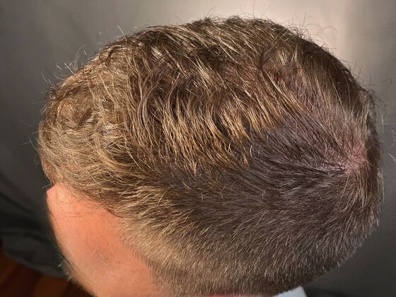 Dr. Bernardino A. Arocha's patient with full head of hair after FUE