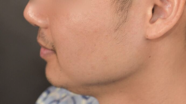 Dr. Bernardino Arocha's patient before FUT beard transplant