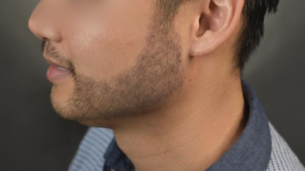 Dr. Bernardino Arocha's patient after FUT beard transplant