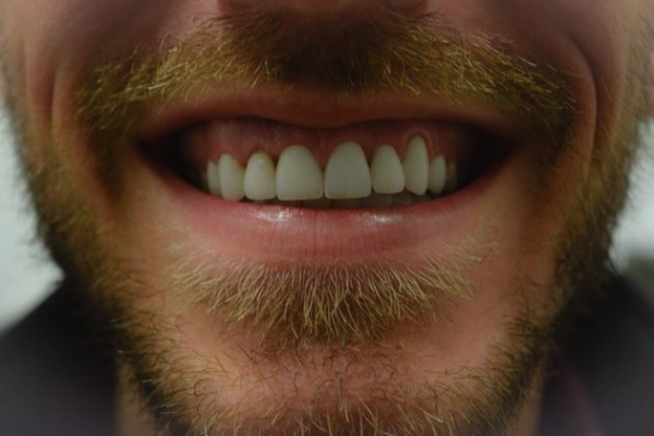 after veneers