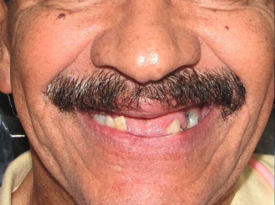 Koyfman Dental patient with missing, broken teeth