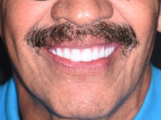 Koyfman Dental patient after All-on-4 dental implant treatment