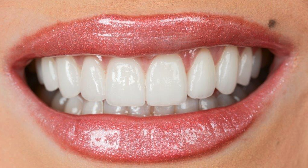 Close up of smiling woman with veneers
