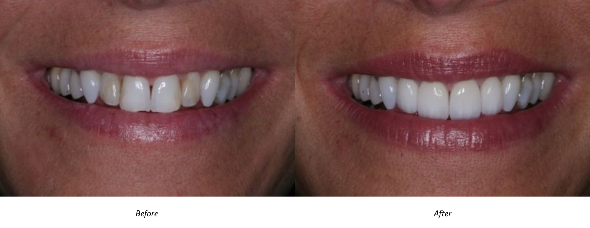 before and after porcelain veneers