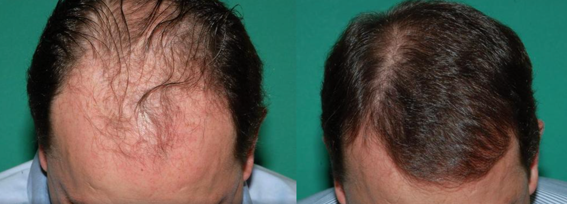 Before and after hair restoration