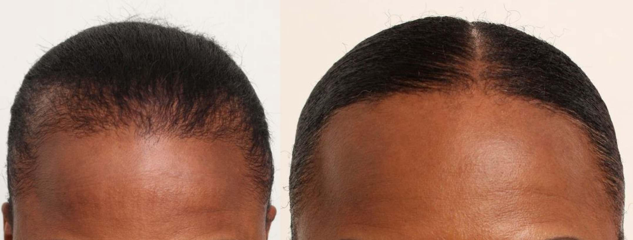 Hair restoration case — traction alopecia, The Hair Loss Doctors