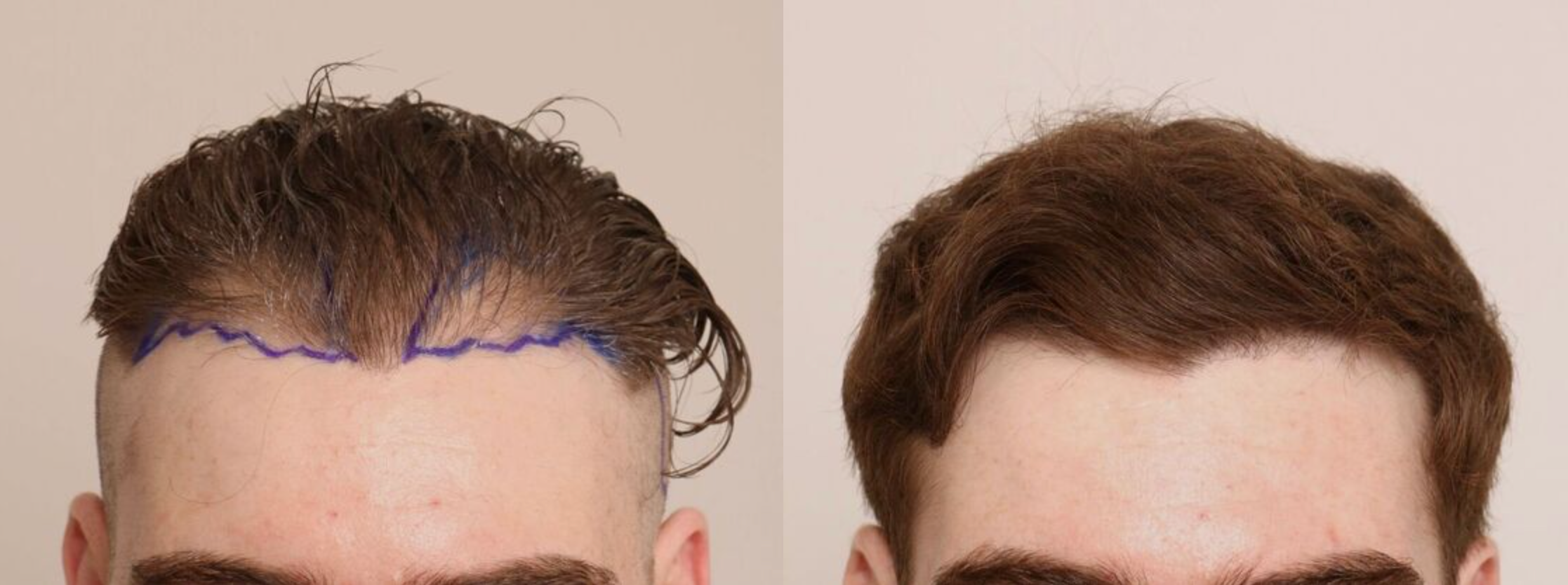 Hair restoration case — receding hairline, The Hair Loss Doctors