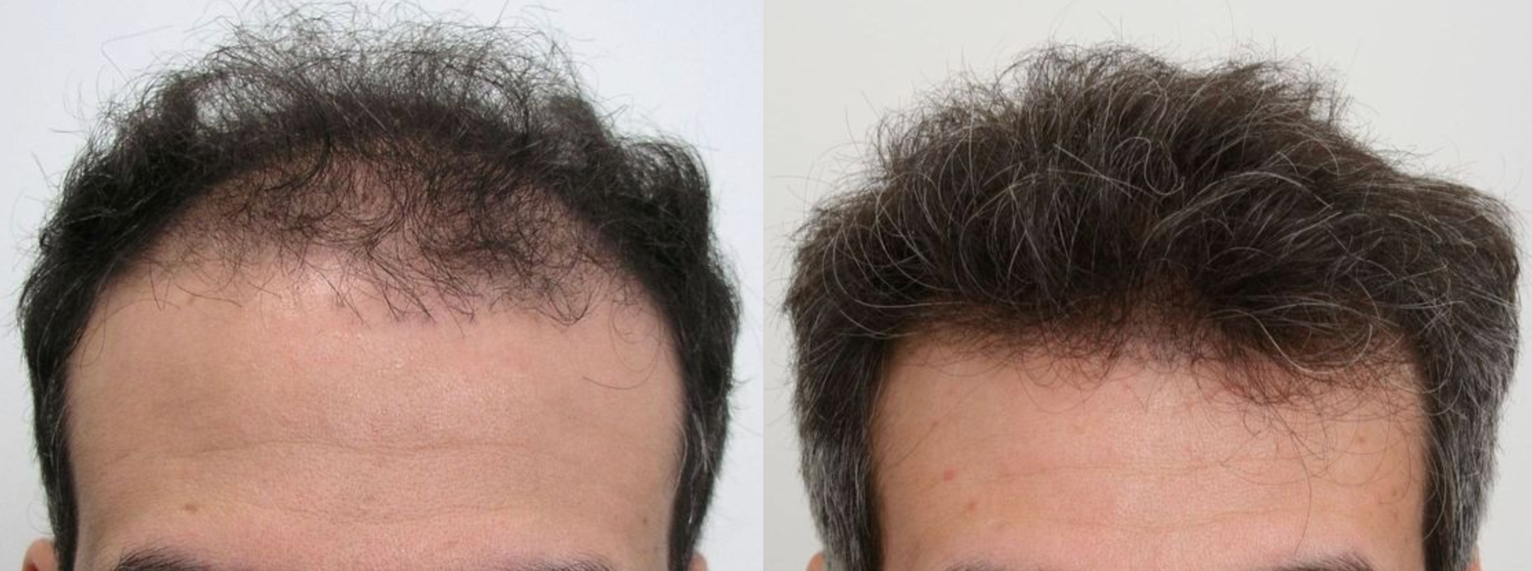 Hair restoration case — widespread thinning, The Hair Loss Doctors