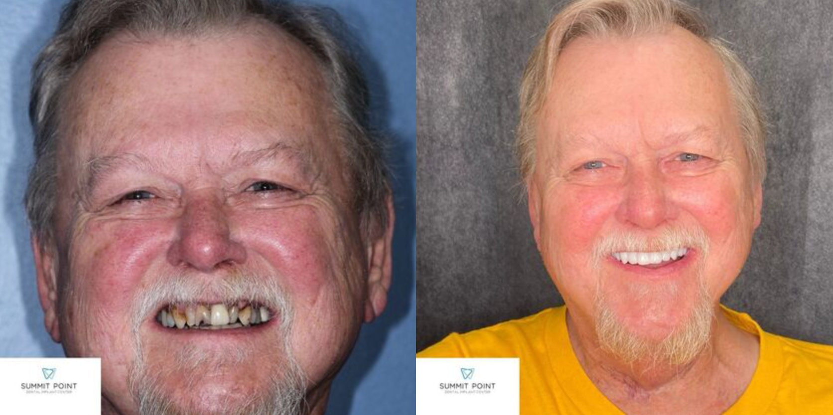 All-on-4 before and after