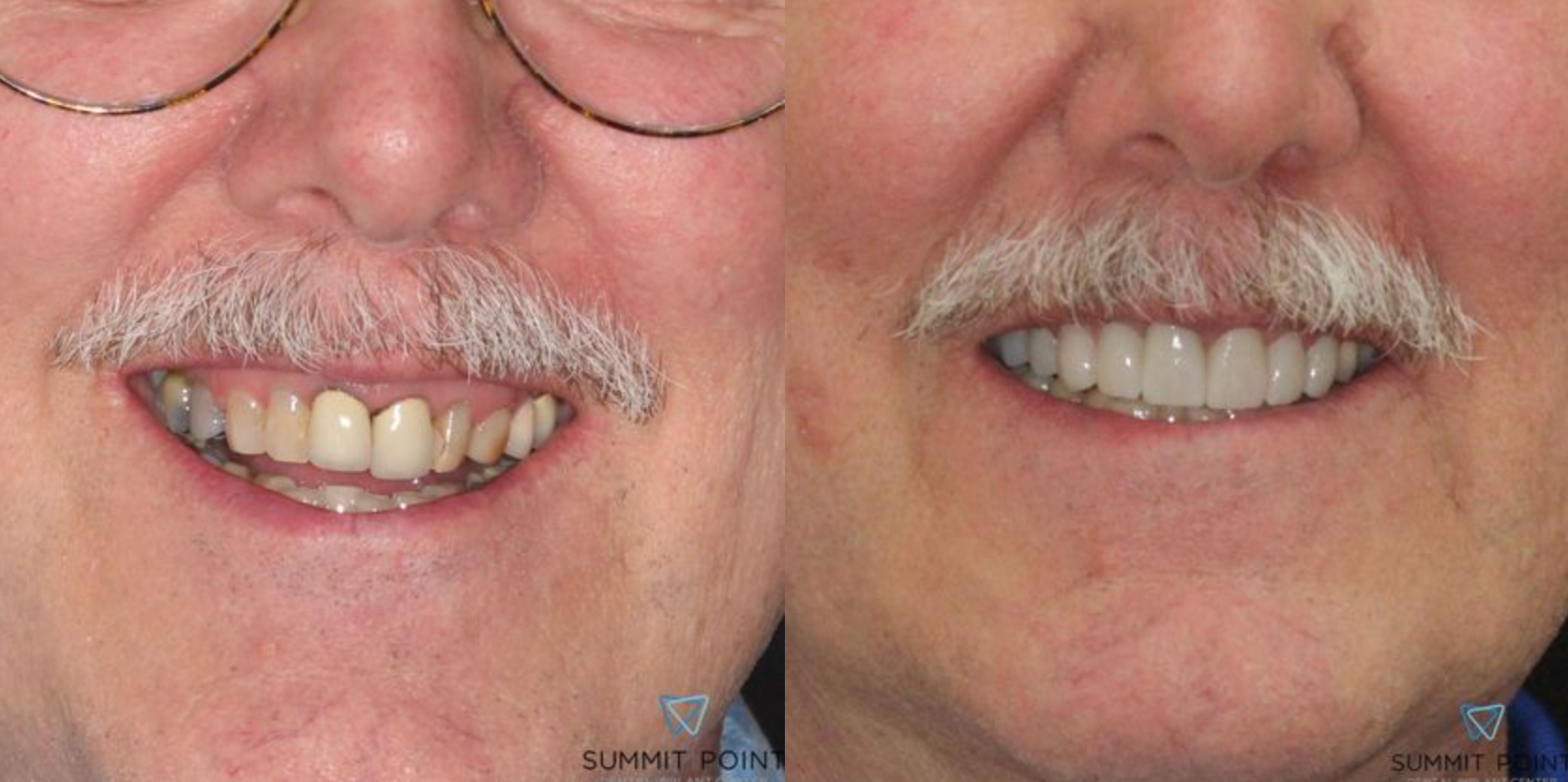 Dental crowns before and after