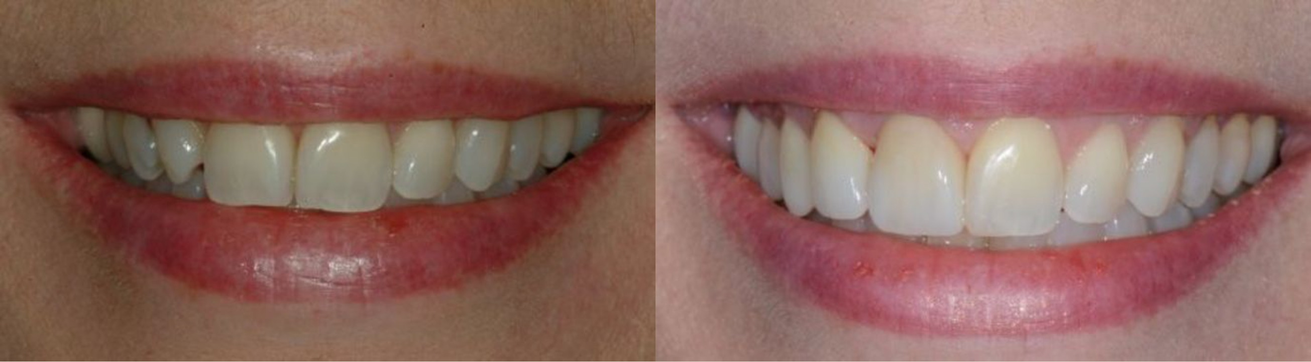 Patient smile before and after porcelain veneers by Dr. Slaman in Albuquerque