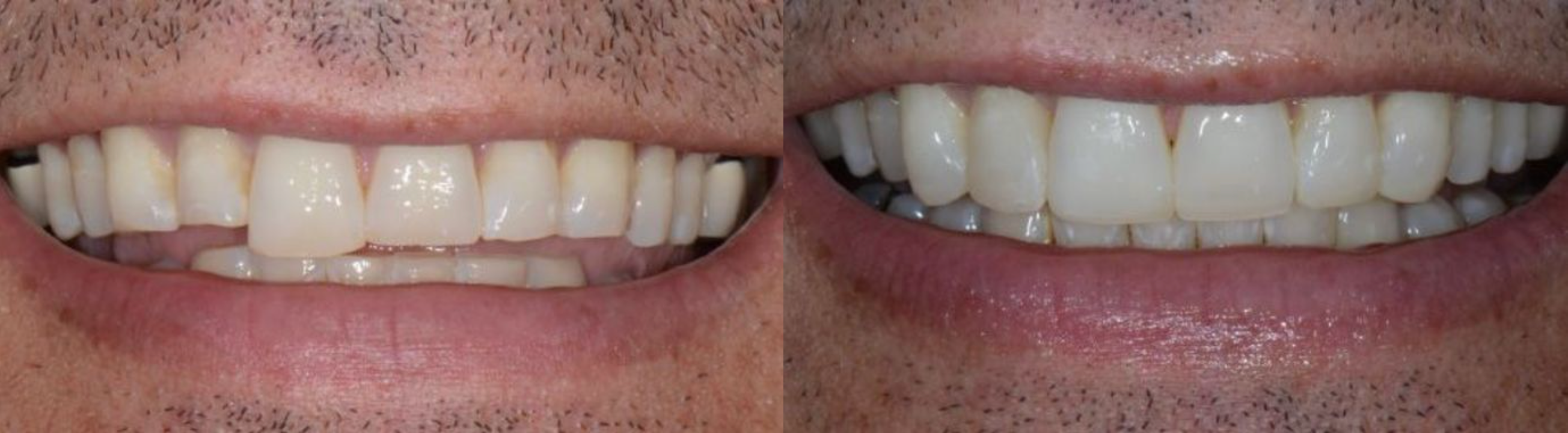 Patient smile before and after dental bonding by Dr. Slaman in Albuquerque